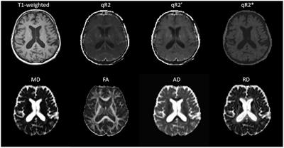 Utility of Multi-Modal MRI for Differentiating of Parkinson's Disease and Progressive Supranuclear Palsy Using Machine Learning